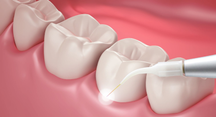 Laser in cosmetic dentistry